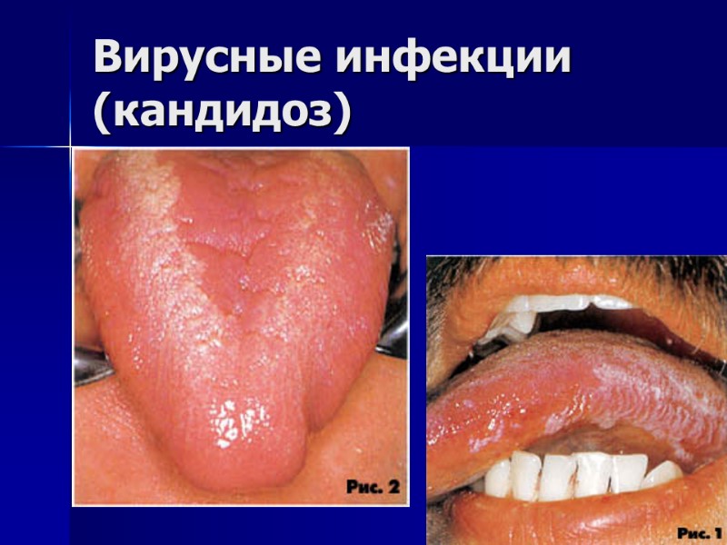 Вирусные инфекции (кандидоз)